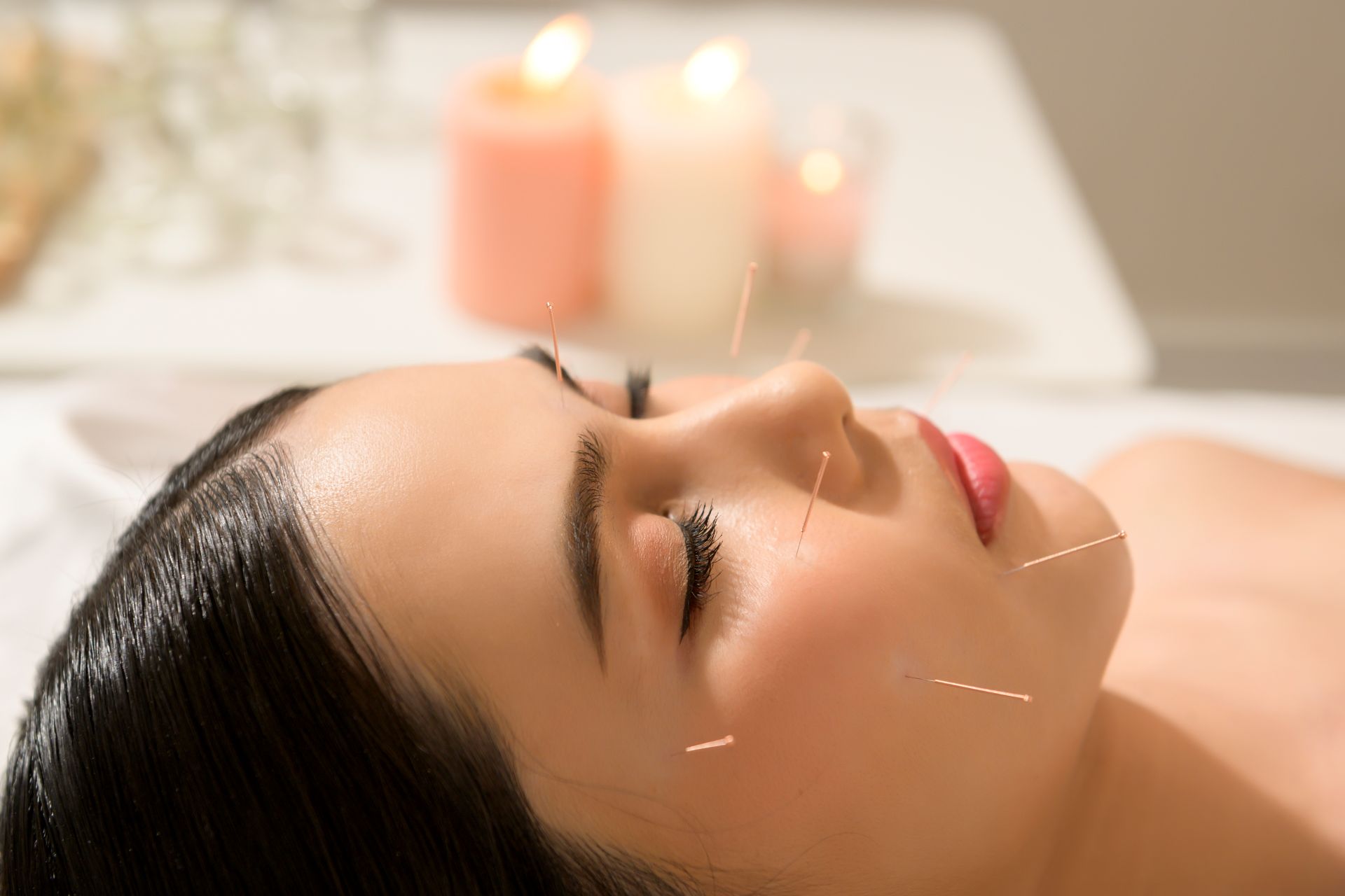 Acupuncture